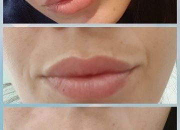 Consumidora 1: melasma na região do buço